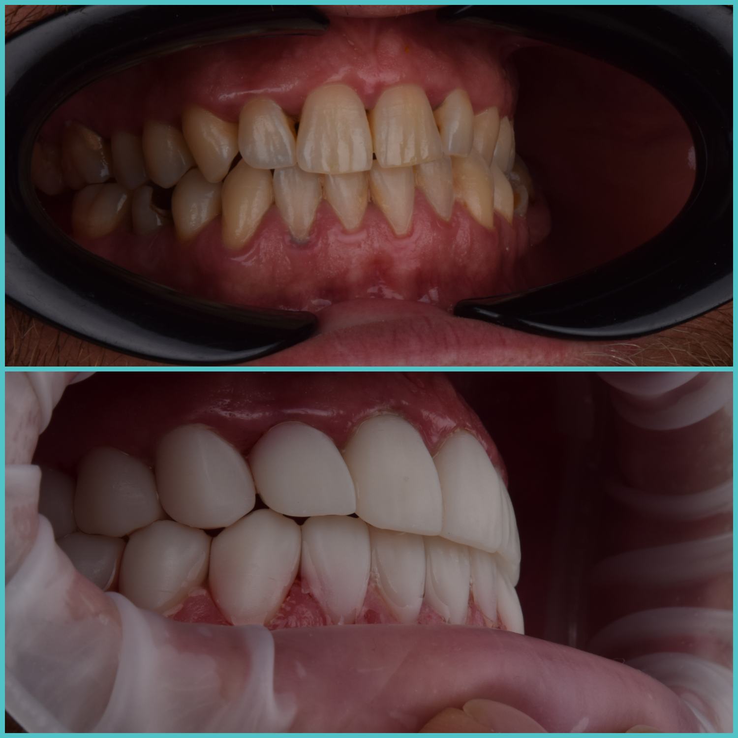 komplette zahnimplantate mit fly2smile
