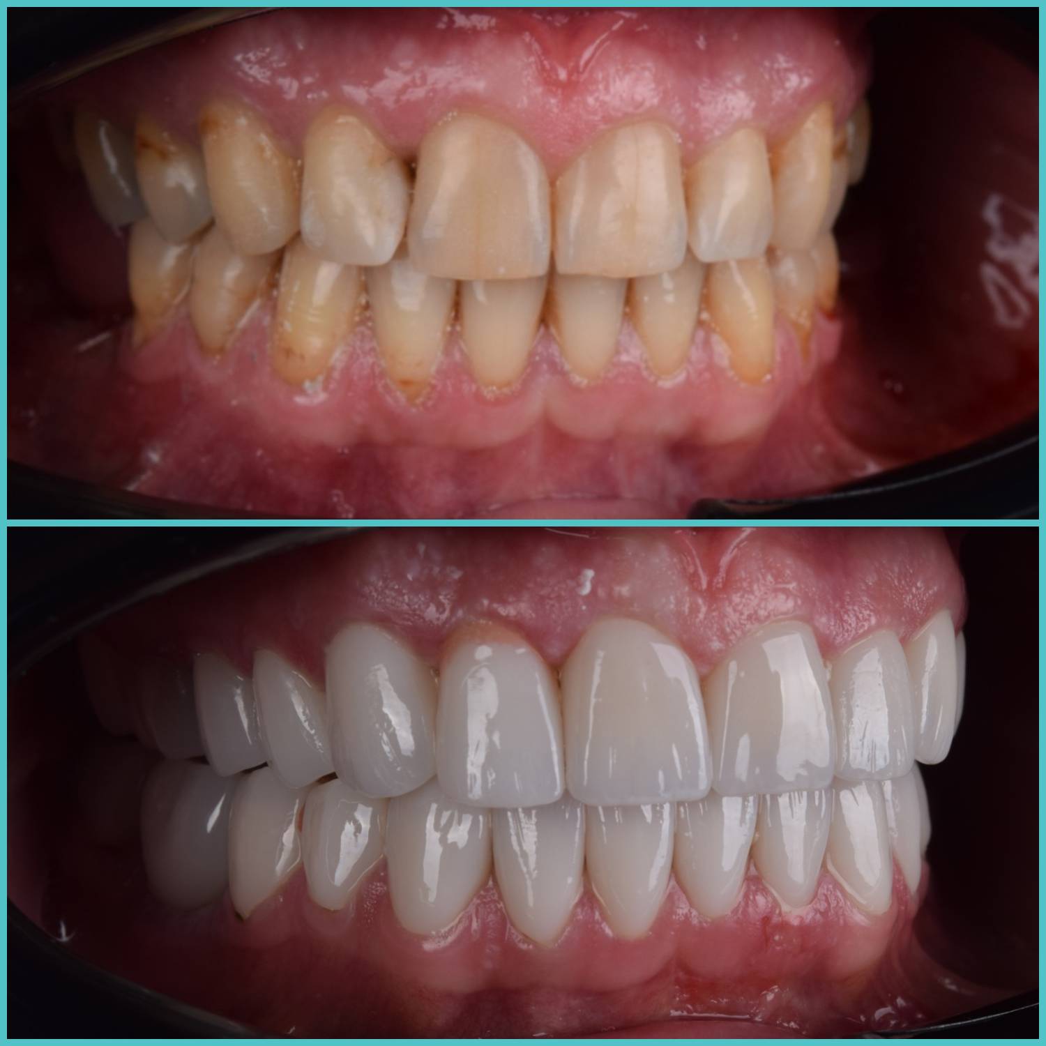 komplette zahnimplantate mit fly2smile