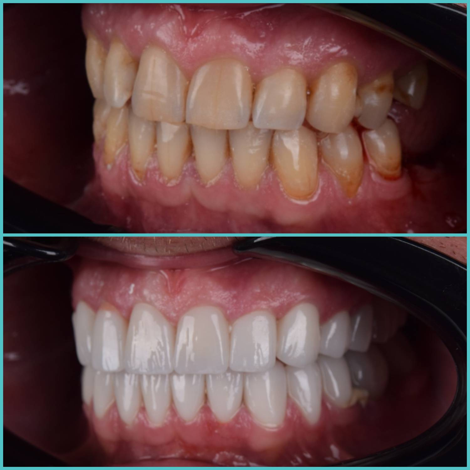 komplette zahnimplantate mit fly2smile