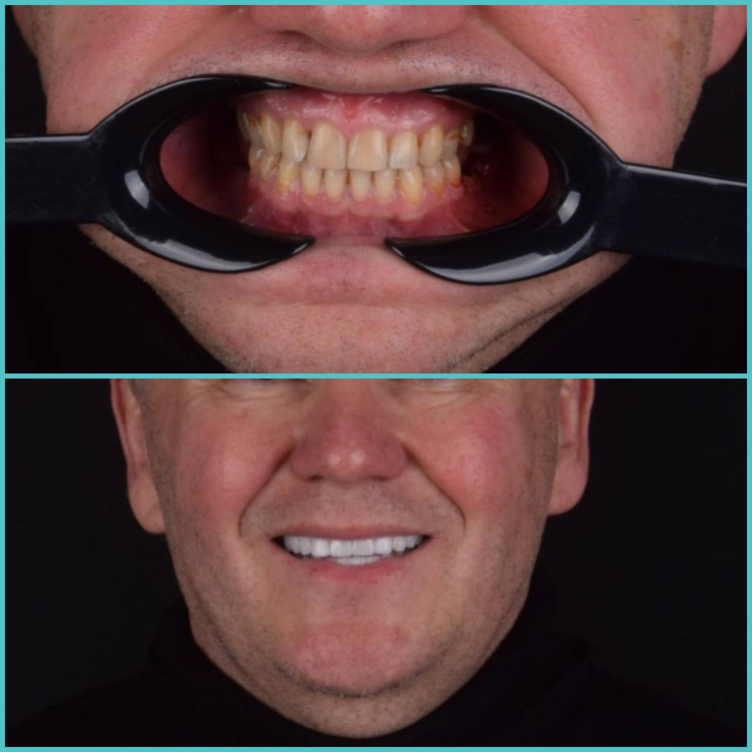 komplette zahnimplantate mit fly2smile
