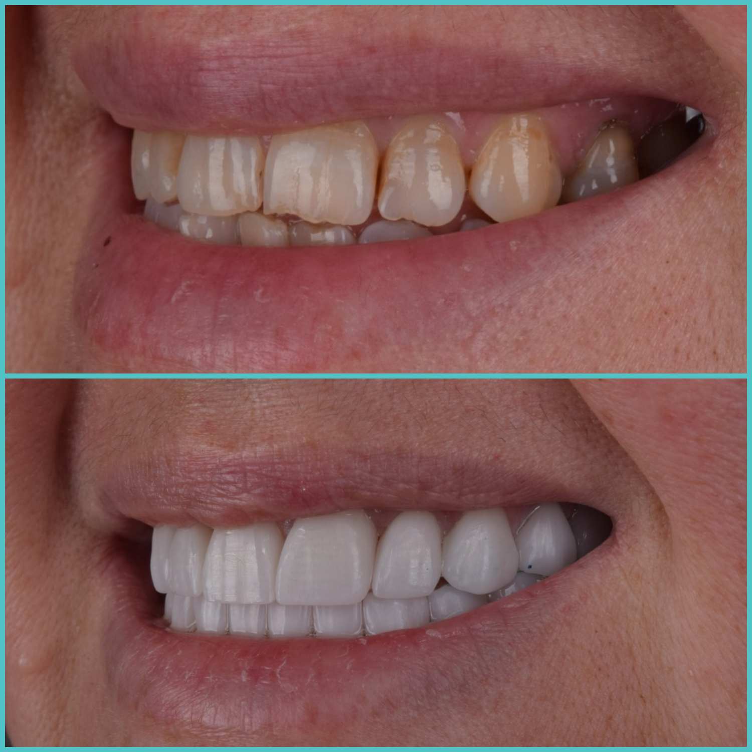 komplette zahnimplantate mit fly2smile