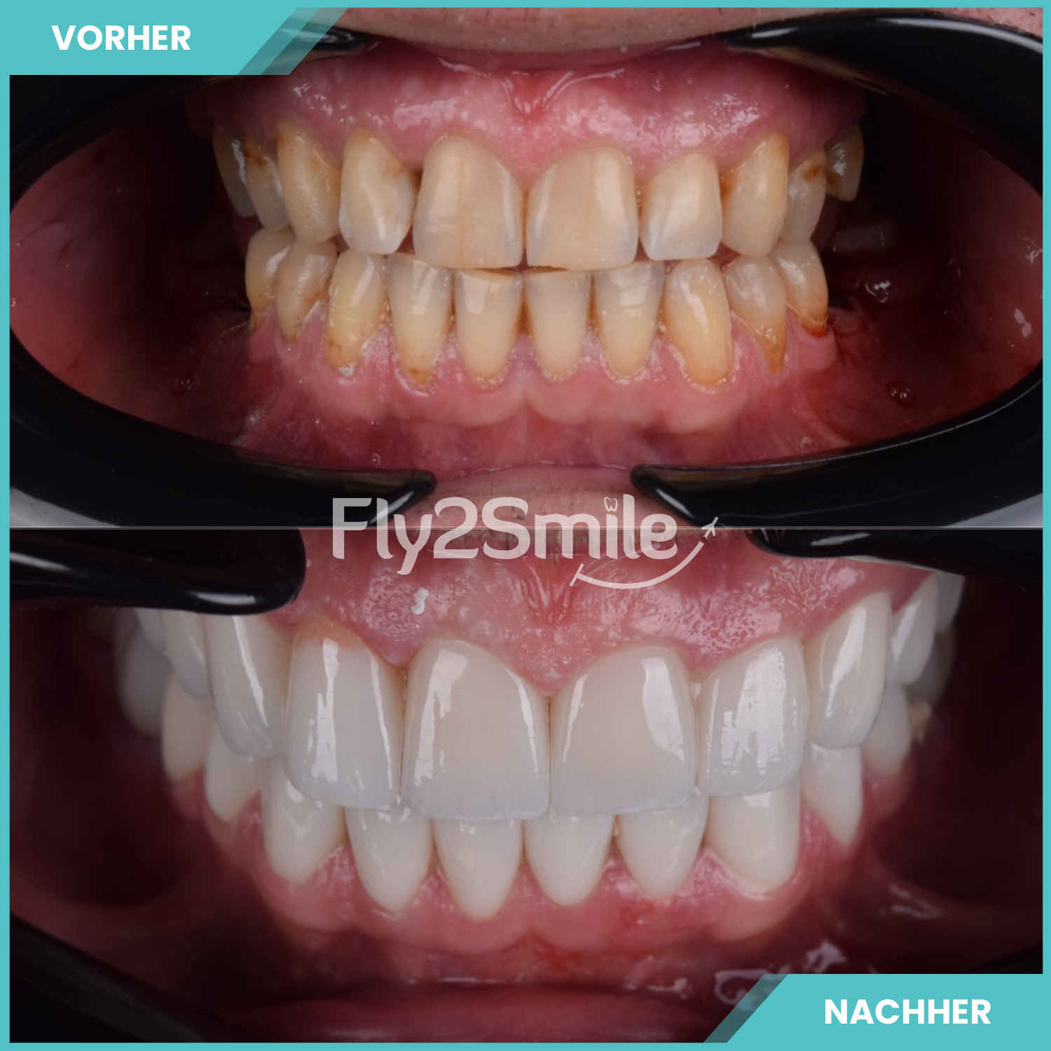 komplette zahnimplantate mit fly2smile
