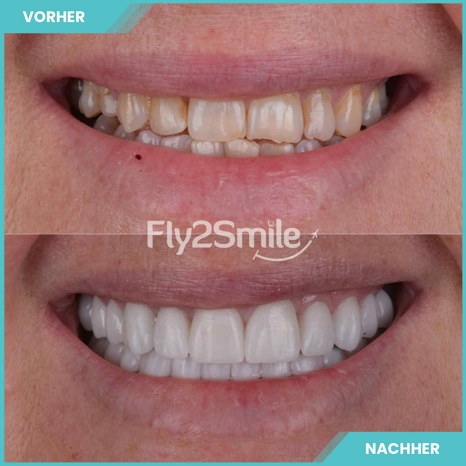 komplette zahnimplantate mit fly2smile