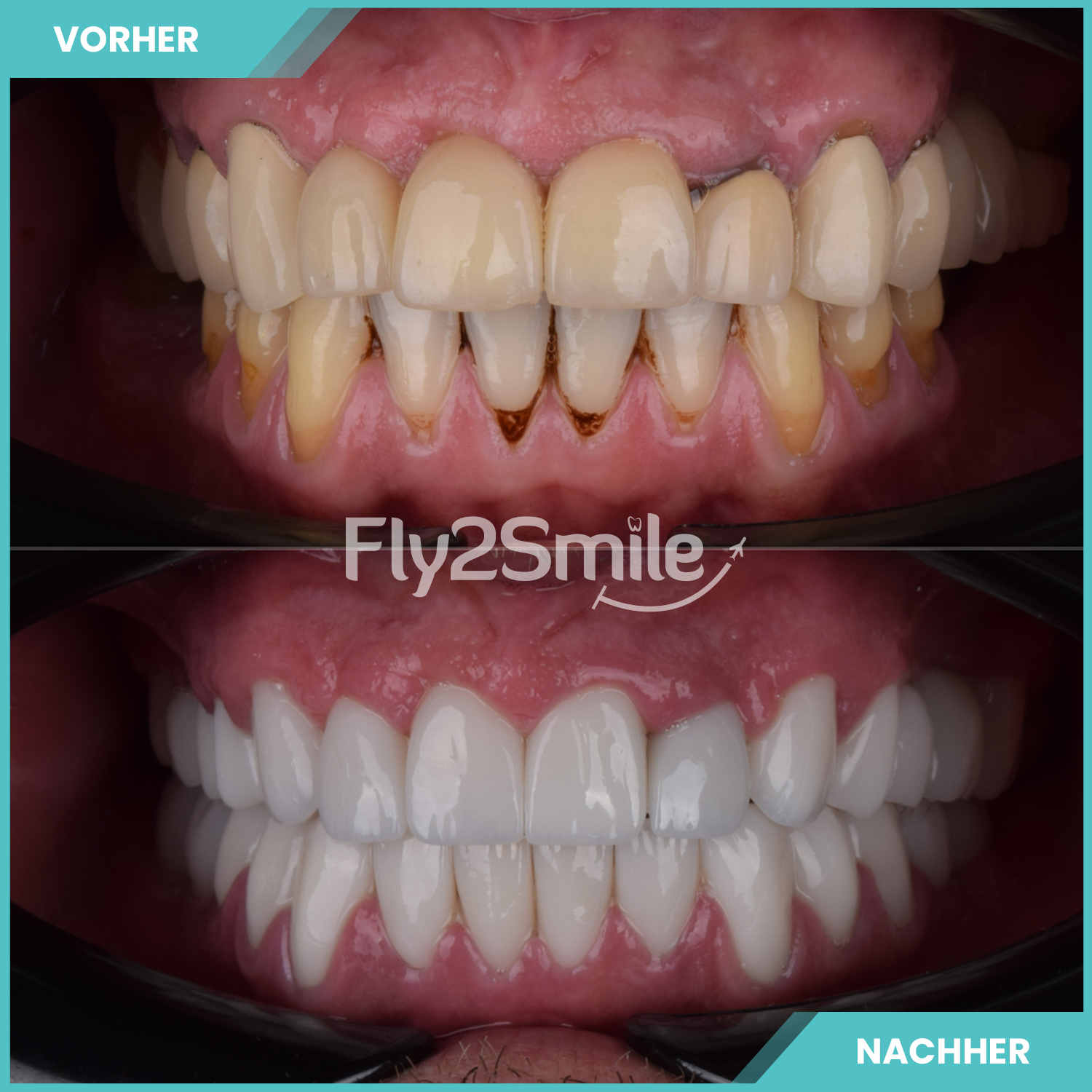 komplette zahnimplantate mit fly2smile