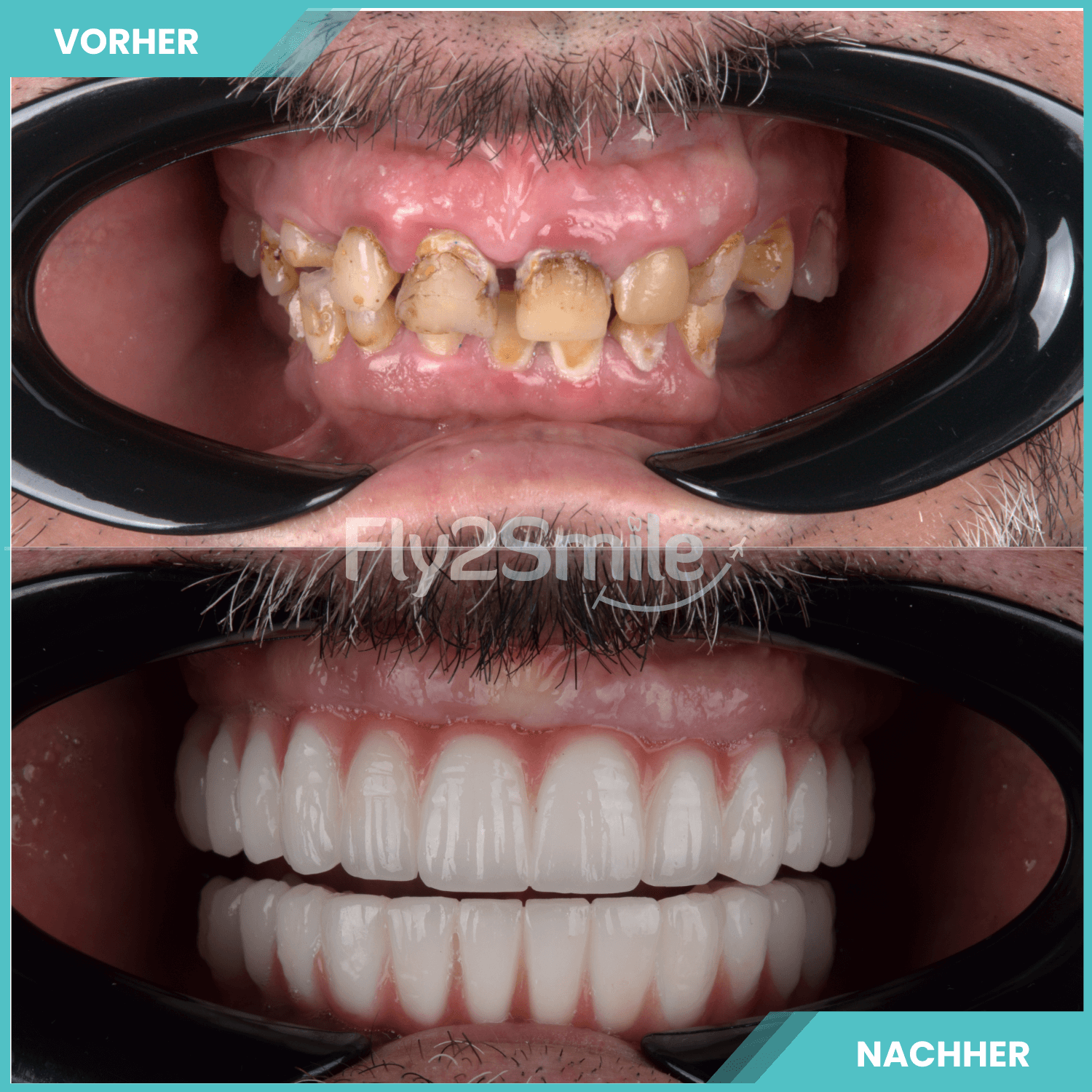 komplette zahnimplantate mit fly2smile