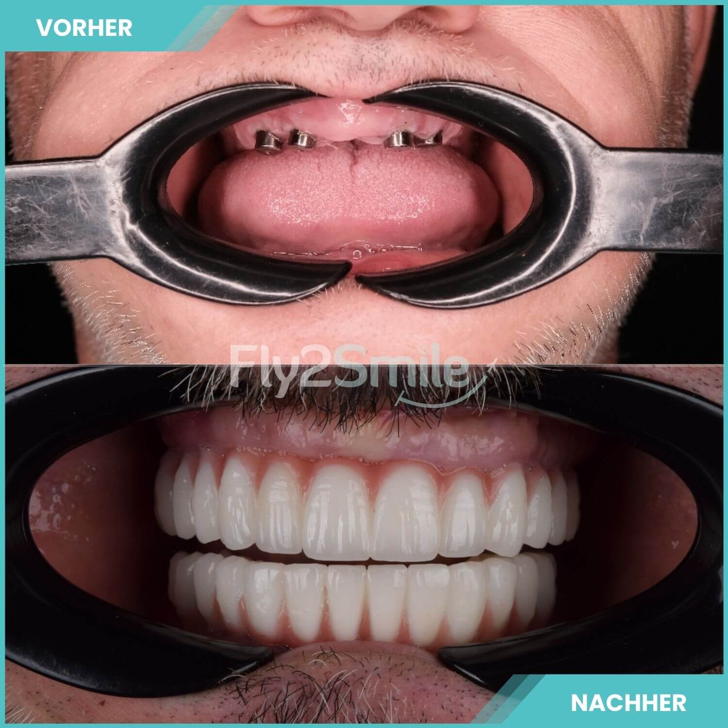 komplette zahnimplantate mit fly2smile