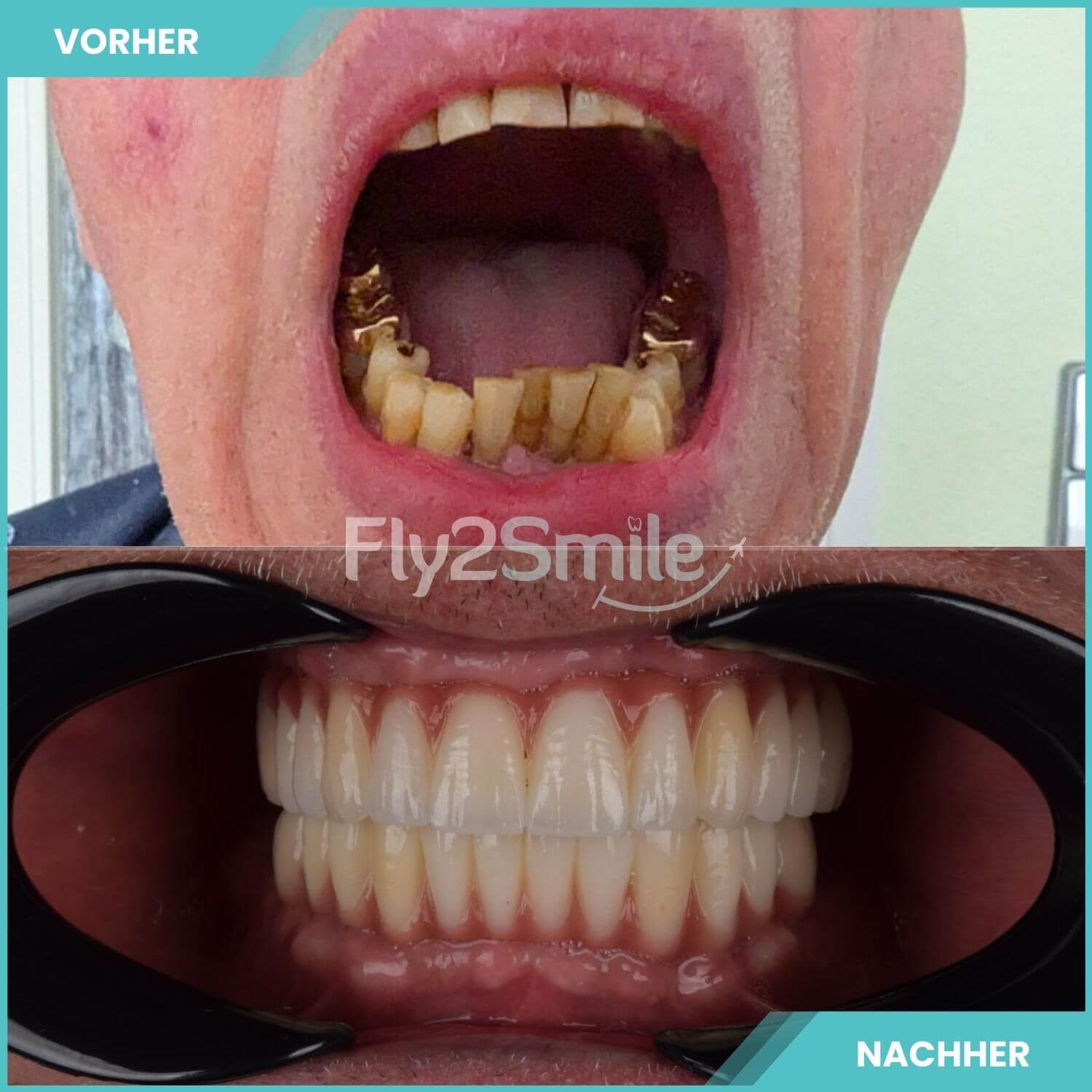 komplette zahnimplantate mit fly2smile