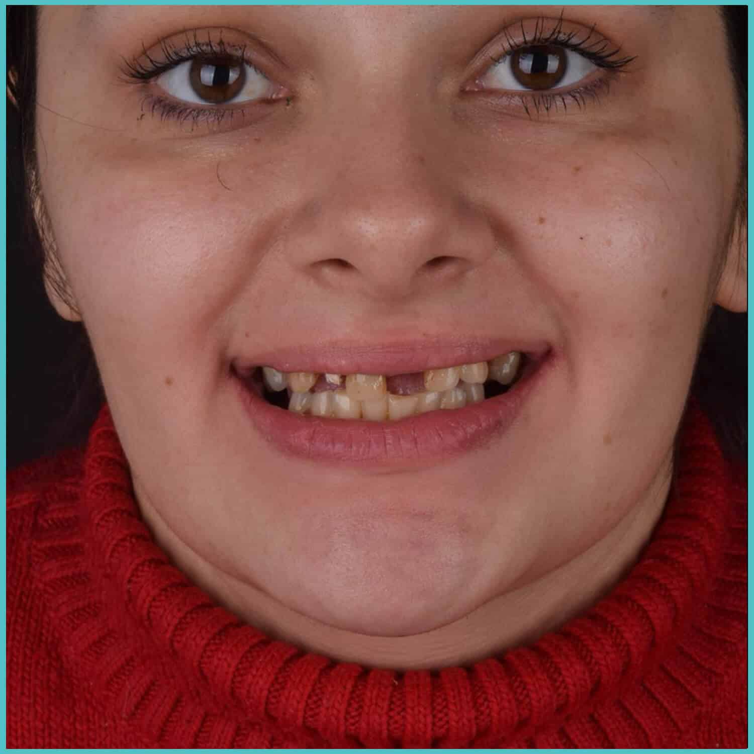 komplette zahnimplantate mit fly2smile
