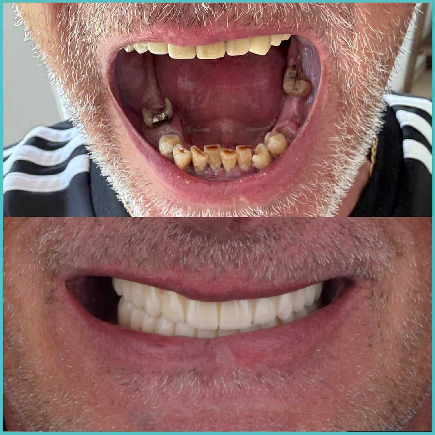 komplette zahnimplantate mit fly2smile