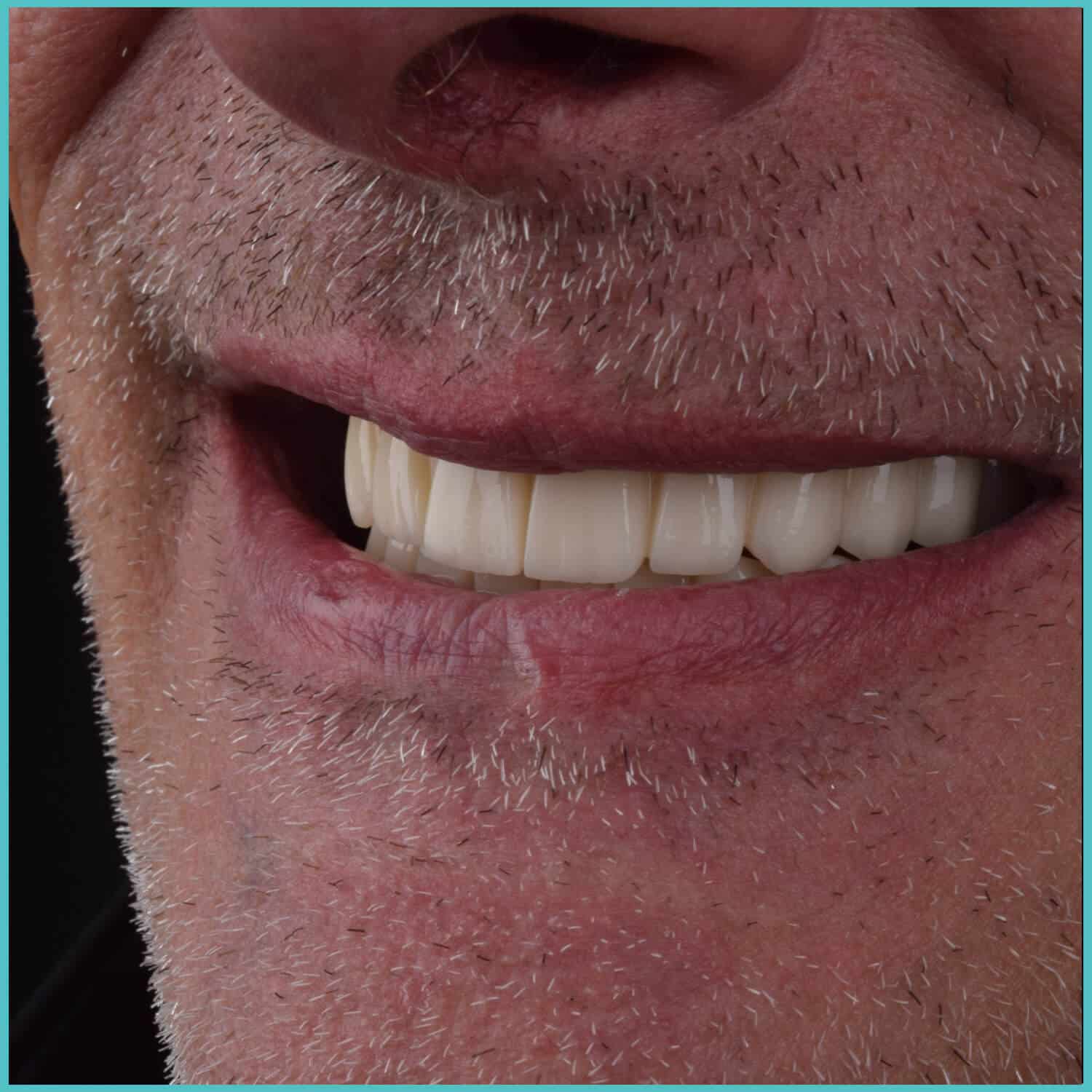 komplette zahnimplantate mit fly2smile