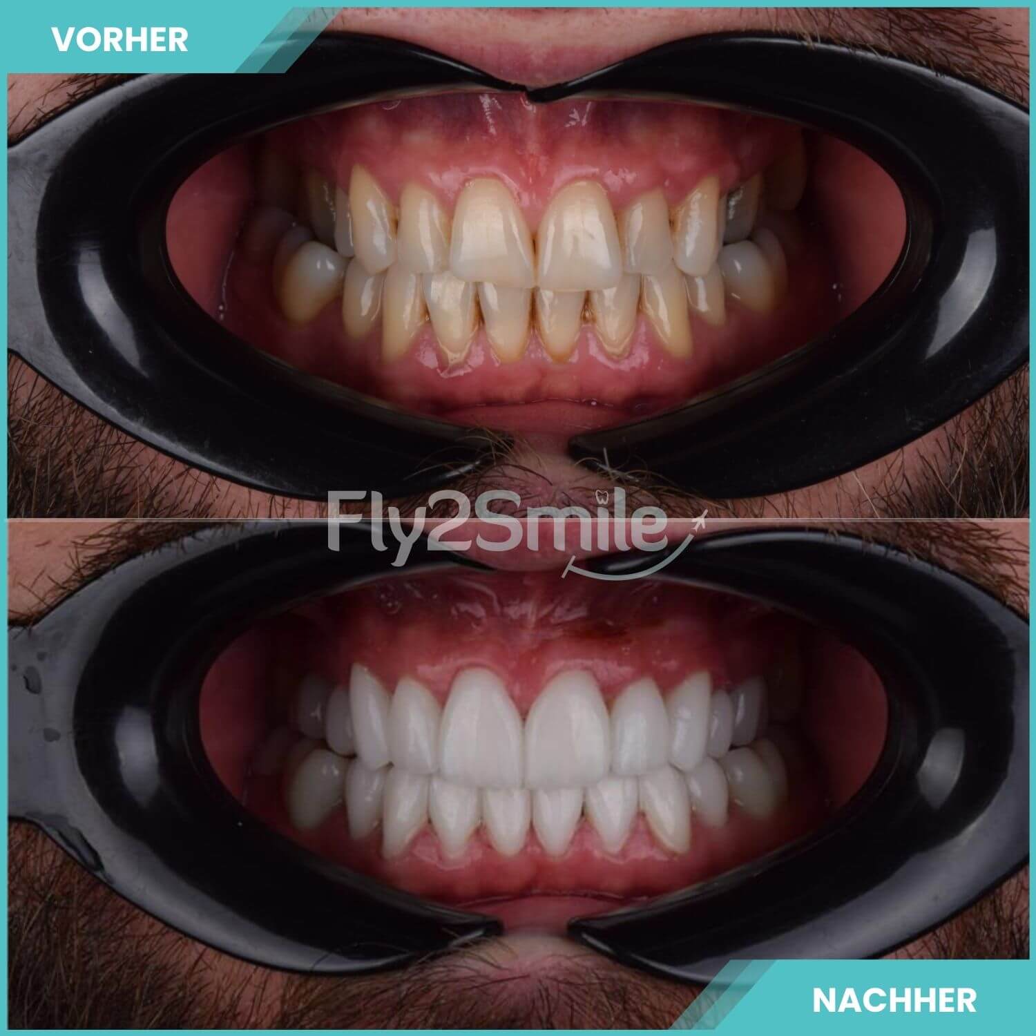 komplette zahnimplantate mit fly2smile