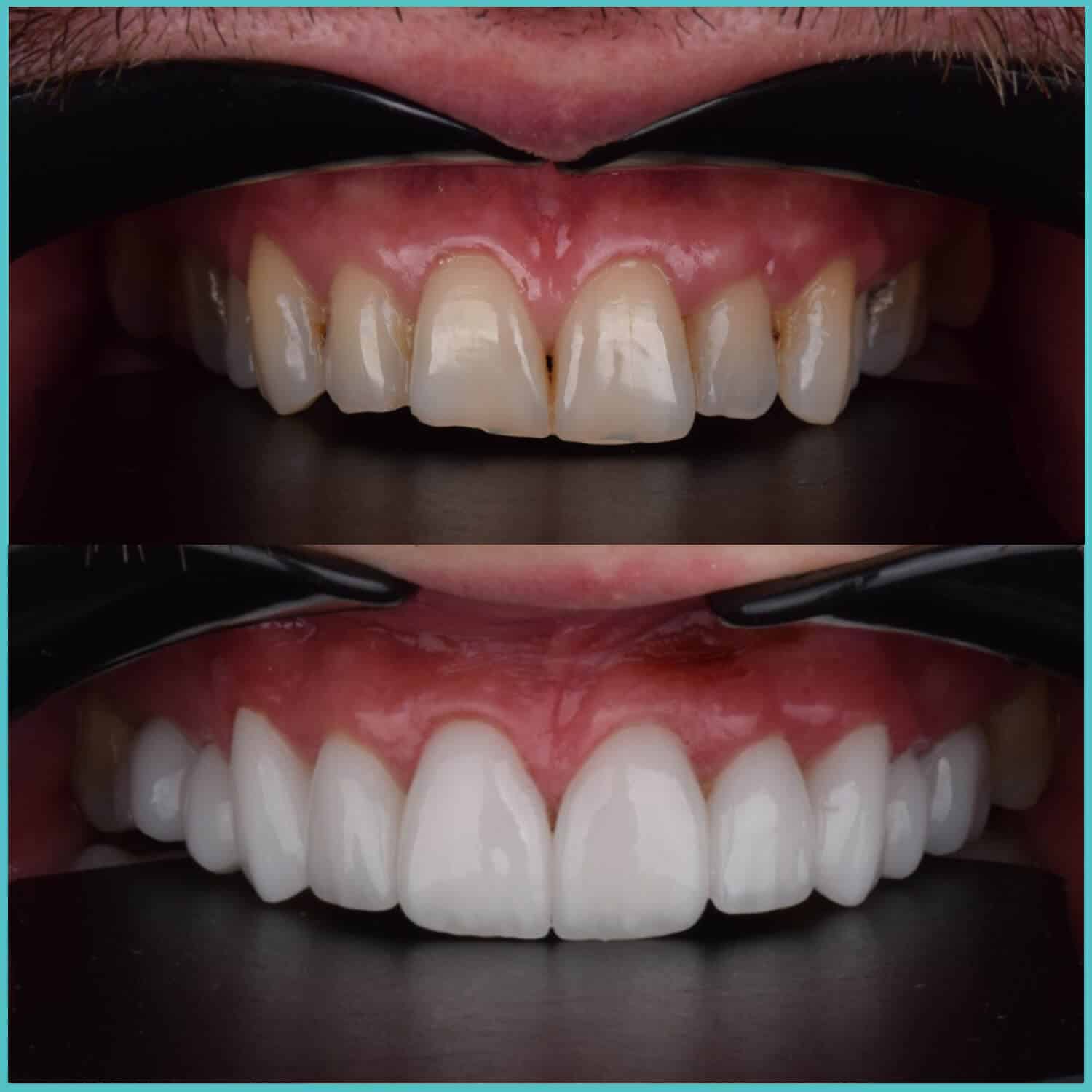 komplette zahnimplantate mit fly2smile